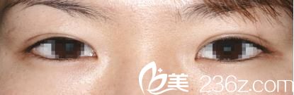 分享暑假期间我去日本找酒井伦明医生做的埋线双眼皮，效果居然是这样的