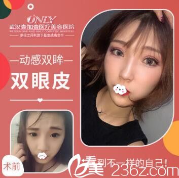 武汉壹加壹李艳冬玫度眉眼双眼皮案例对比图