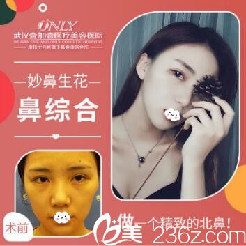 武汉壹加壹付俊利韩式生科鼻综合隆鼻案例效果对比图