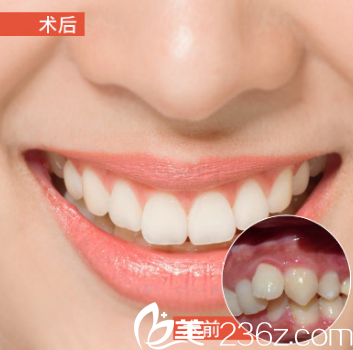 武汉壹加壹周宁金属托槽矫正案例