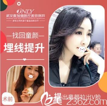武汉壹加壹王政祥面部线雕埋线提升案例效果图