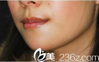 日本哪个医生擅长下巴整形?看我在日本酒井形成外科医院苅部大輔医生那里做的假体植入垫下巴