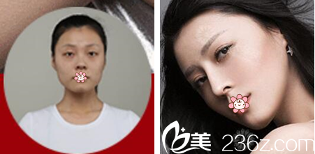 重庆华美隆鼻案例 重庆华美隆鼻案例