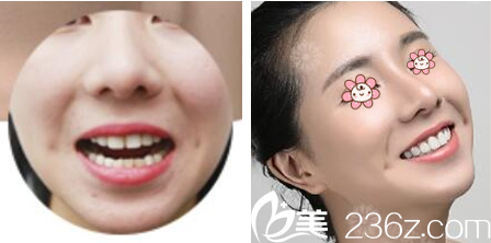 重庆华美牙贴面案例 重庆华美牙贴面案例