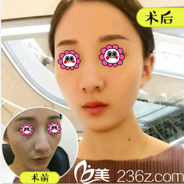 北京壹加壹奥美定/不明注射物取出优惠进行中！价格2980元起附案例