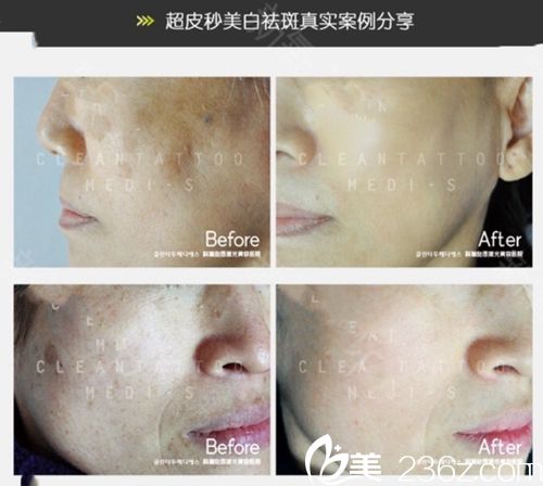 韩国科琳挞图皮肤科双皮秒美白祛斑 韩国科琳挞图皮肤科双皮秒美白祛斑