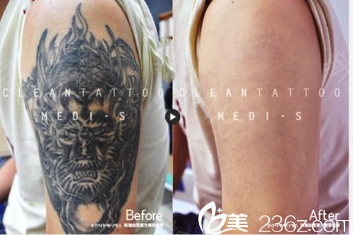 韩国科琳挞图皮肤科去纹身 韩国科琳挞图皮肤科去纹身