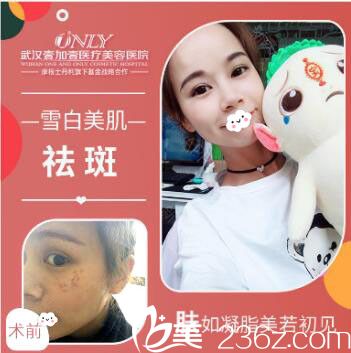 武汉壹加壹医疗美容医院杨丽萍激光祛斑案例效果对比图 武汉壹加壹医疗美容医院杨丽萍激光祛斑案例效果对比图