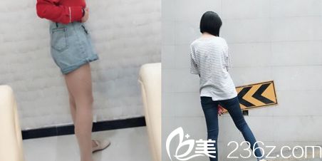 华廷医美燃脂塑身术后对比效果