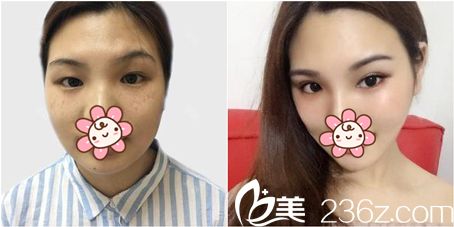 华廷医美激光嫩肤祛斑效果图