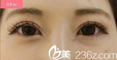 揭秘日式无痕双眼皮真相，在东京ISEA整形外科医院做了全切双眼皮开眼角后感觉整个世界都变了