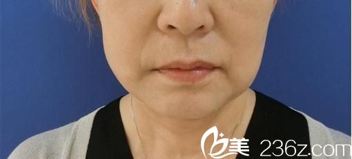 多大年纪适合做面部拉皮?60岁的我去日本东京ISEA整形外科医院做面部提拉后变成了这个样子