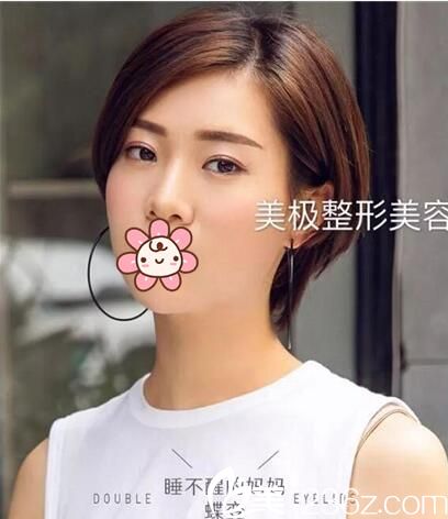 成都美极刘洁双眼皮修复手术案例