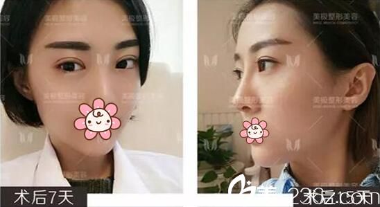 刘洁线雕双眼皮拆线后效果