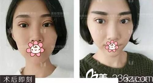 成都美极刘洁双眼皮修复手术术后即刻