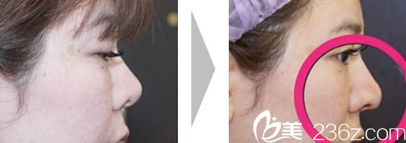 池田欣生鼻尖形成术前后对比 池田欣生鼻尖形成术前后对比