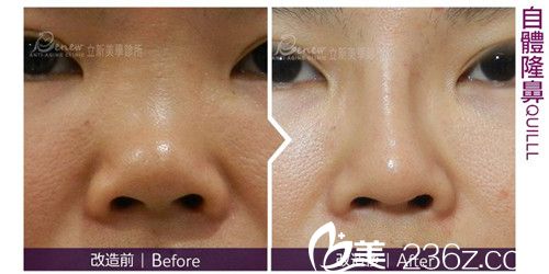 中国台湾立新美学诊所自体隆鼻手术对比图 中国台湾立新美学诊所自体隆鼻手术对比图
