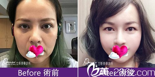 中国台湾立新美学诊所颜仲毅做的拉皮手术