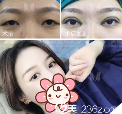 成都美极双眼皮术前术后对比 成都美极双眼皮术前术后对比