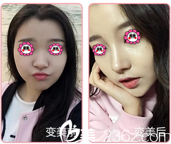 北京百达丽半肋软骨鼻综合隆鼻特惠进行中！价格30000元起