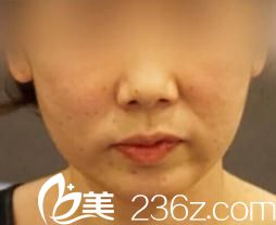 去日本东京皮肤科形成外科医院找池田欣生做了面部埋线提升，看到较终效果我沉默了