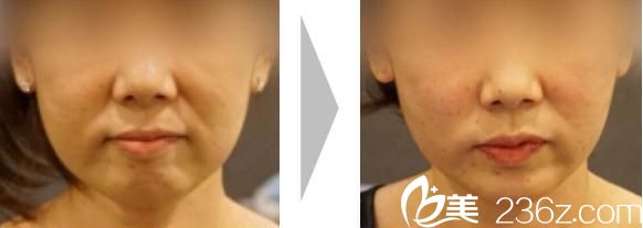 池田欣生面部埋线提升前后对比 池田欣生面部埋线提升前后对比