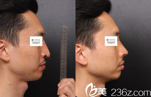 鼻整形真人前后对比效果 鼻整形真人前后对比效果