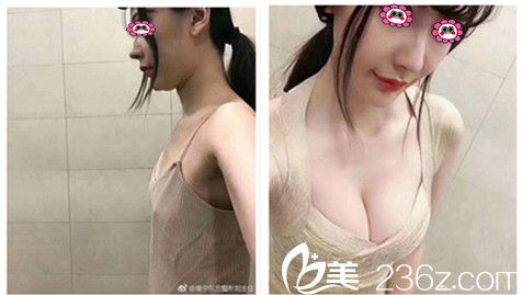 南宁东方赵波隆胸变化图