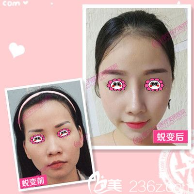 东方整形医院隆鼻效果图 东方整形医院隆鼻效果图