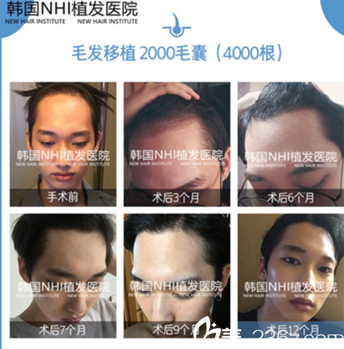 韩国江南NHI植发医院毛发移植案例 韩国江南NHI植发医院毛发移植案例