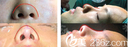 隆鼻真人示意图 隆鼻真人示意图