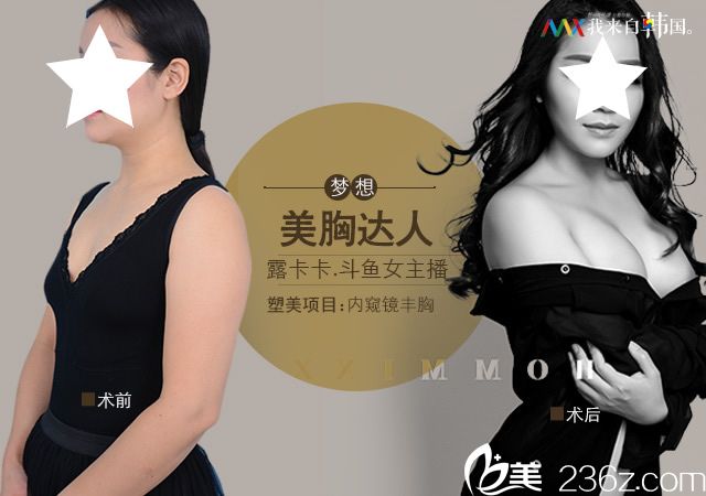 南宁梦想整形内窥镜隆胸案例