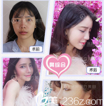 烟台洛神隆鼻案例 烟台洛神隆鼻案例