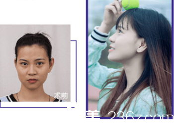 烟台华怡隆鼻案例 烟台华怡隆鼻案例