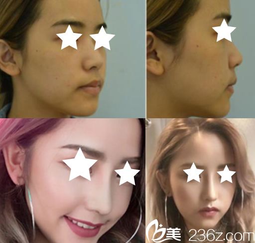 南宁梦想整形鼻综合前后对比图