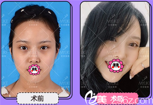 北京美莱眼部修复整形优惠活动已上线！双眼皮修复21000元起活动海报五