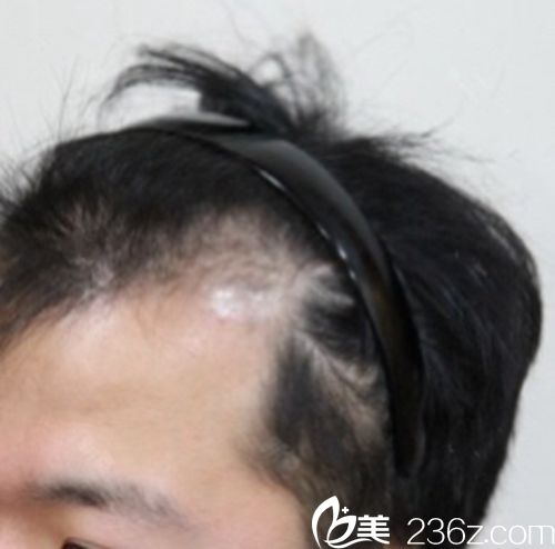 韩国江南NHI植发医院种植发际线术前 韩国江南NHI植发医院种植发际线术前