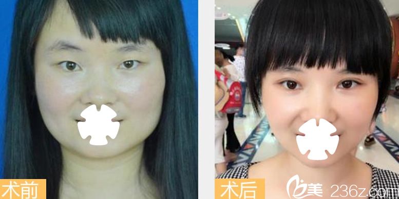 南宁梦想整形双眼皮加开眼角案例图