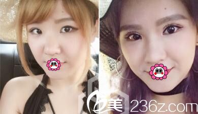 中国台湾首席整形混血瞳手术案例