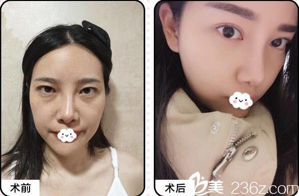 武汉割双眼皮哪家医院好?武汉美基元项利姣双眼皮修复案例 武汉割双眼皮哪家医院好?武汉美基元项利姣双眼皮修复案例