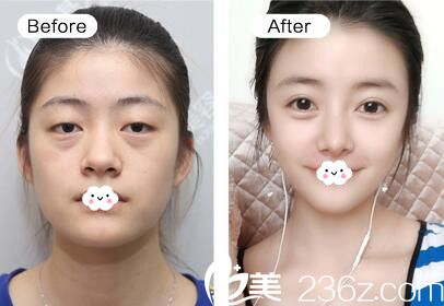 武汉美基元鼻修复真人案例 武汉美基元鼻修复真人案例