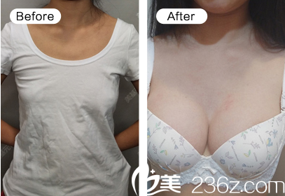 武汉美基元假体隆胸案例效果对比图 武汉美基元假体隆胸案例效果对比图