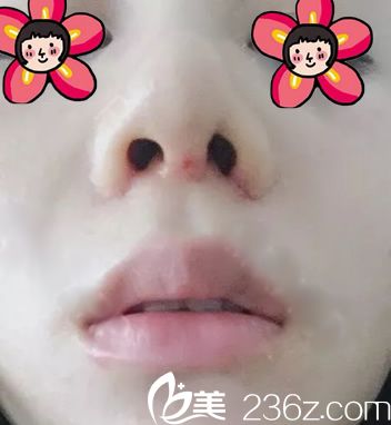 在杭州美联致美萧山分院找原公立医院的吴明龙院长做了膨体隆鼻 耳