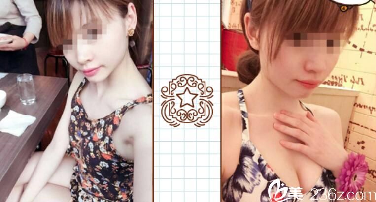 勇中华自体脂肪隆胸案例效果前后对比