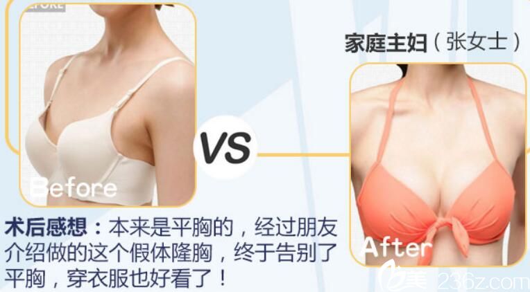阜阳东方美莱坞整形假体隆胸术前术后对比案例