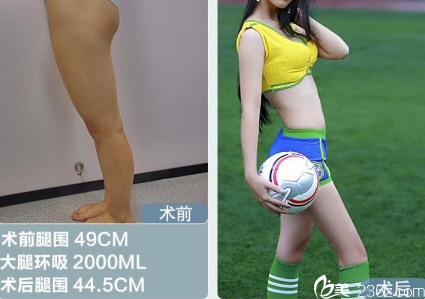 找阜阳东方美莱坞勇中华做大腿吸脂案例前后效果对比图