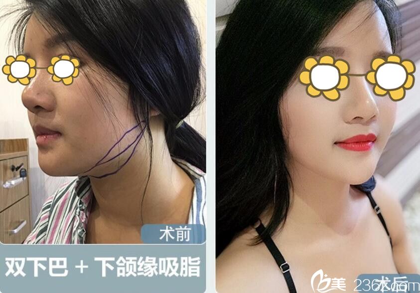 属于阜阳东方美莱坞的面部吸脂瘦脸案例