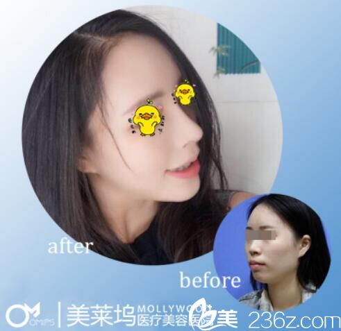 阜阳美莱坞安全？看隆鼻案例及顾客反馈