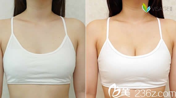 中国台湾慕颜自体脂肪丰胸前后对比案例照片