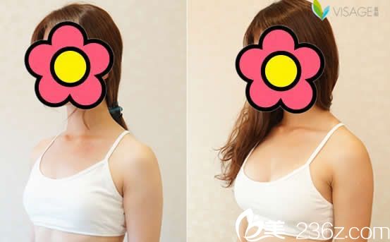 台北慕颜整形胡岱霖内窥镜果冻隆胸效果怎么样 台北慕颜整形胡岱霖内窥镜果冻隆胸效果怎么样